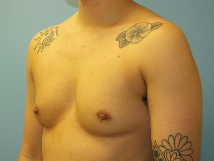 Female to Male Before & After Patient #16117