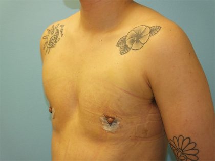 Female to Male Before & After Patient #16117