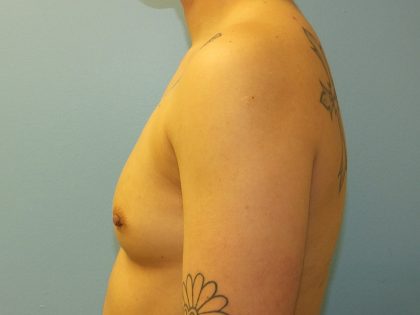Female to Male Before & After Patient #16117