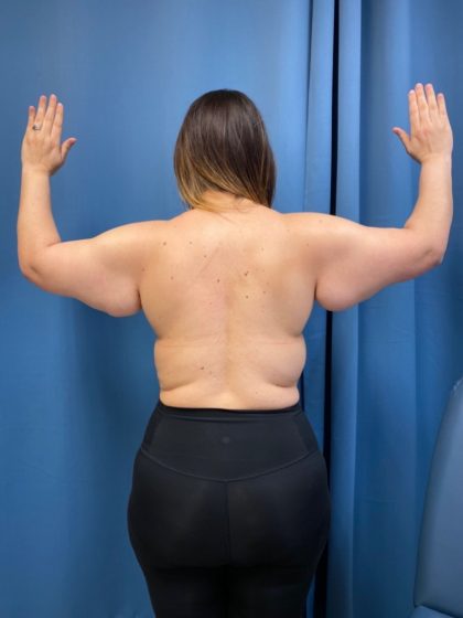 Arm Lift Before & After Patient #16278