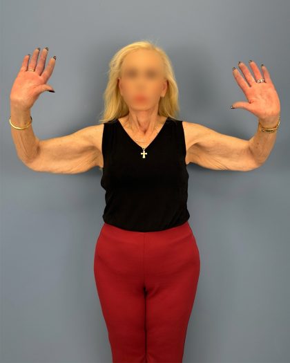 Arm Lift Before & After Patient #16269