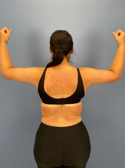 Arm Lift Before & After Patient #16278