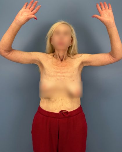 Arm Lift Before & After Patient #16269