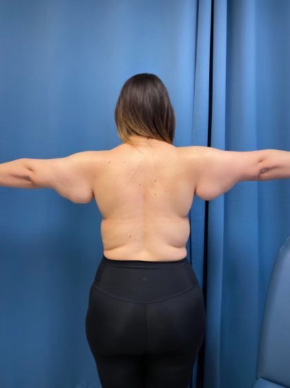 Arm Lift Before & After Patient #16278