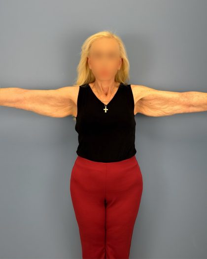 Arm Lift Before & After Patient #16269