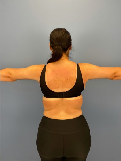 Arm Lift Before & After Patient #16278