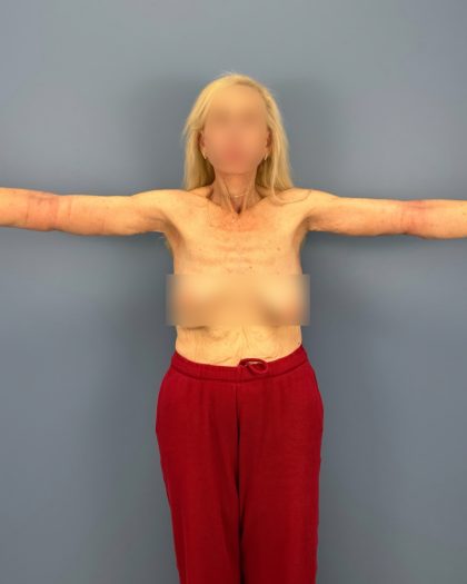 Arm Lift Before & After Patient #16269