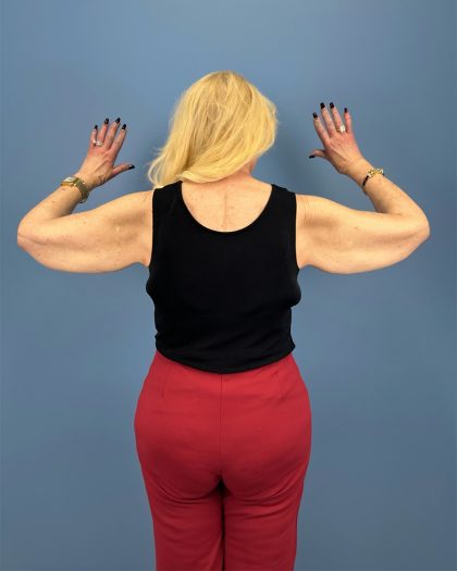 Arm Lift Before & After Patient #16269