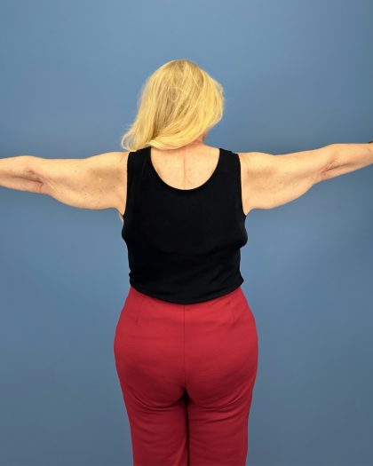Arm Lift Before & After Patient #16269