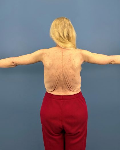 Arm Lift Before & After Patient #16269