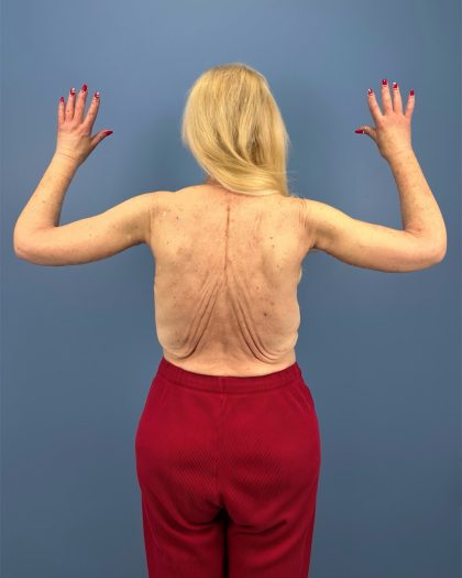 Arm Lift Before & After Patient #16269