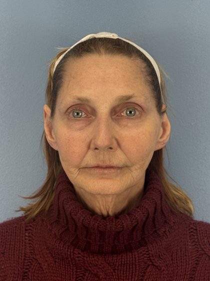 CO2 Laser Before & After Patient #16384