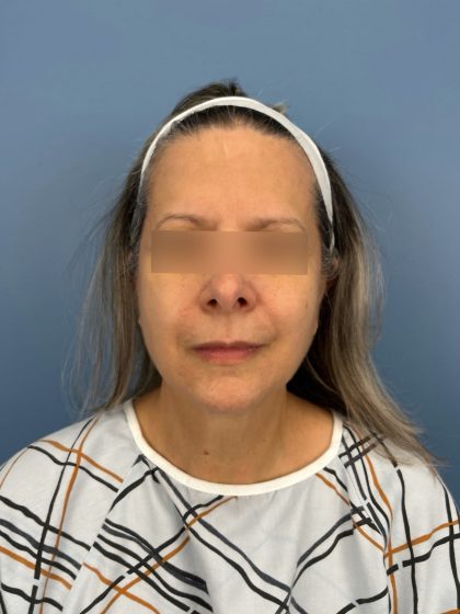 Facelift and Necklift Before & After Patient #16300