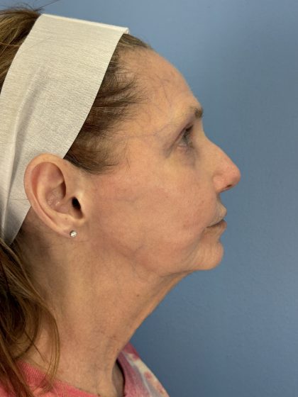 CO2 Laser Before & After Patient #16384