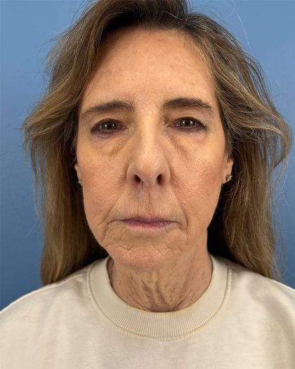 CO2 Laser Before & After Patient #16399