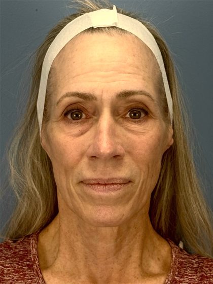 CO2 Laser Before & After Patient #16417