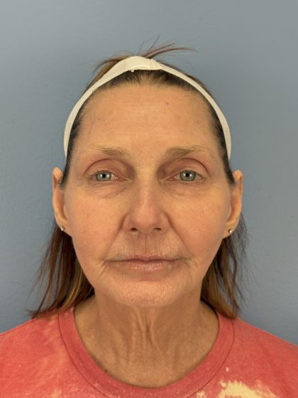 CO2 Laser Before & After Patient #16384