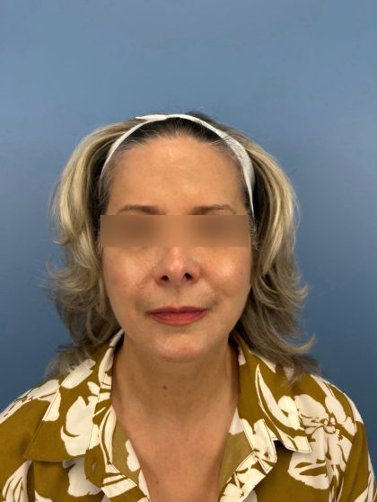 Facelift and Necklift Before & After Patient #16300