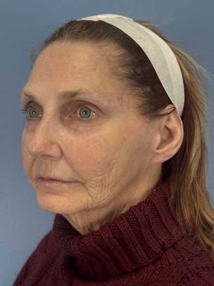 CO2 Laser Before & After Patient #16384