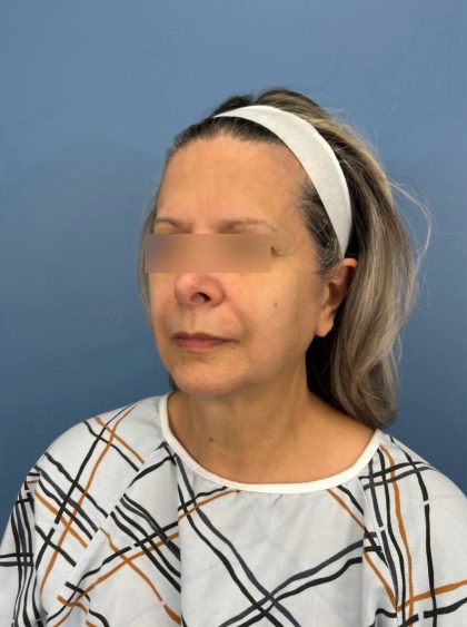 Facelift and Necklift Before & After Patient #16300