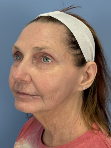 CO2 Laser Before & After Patient #16384