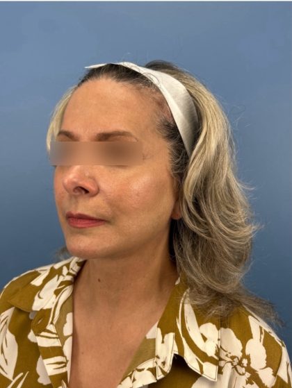 Facelift and Necklift Before & After Patient #16300