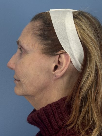 CO2 Laser Before & After Patient #16384