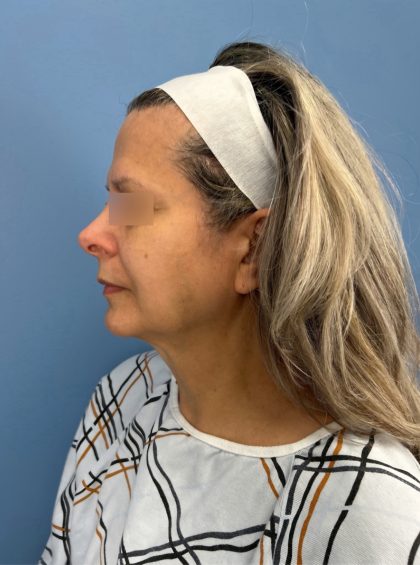 Facelift and Necklift Before & After Patient #16300