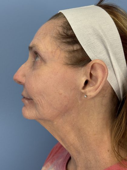 CO2 Laser Before & After Patient #16384