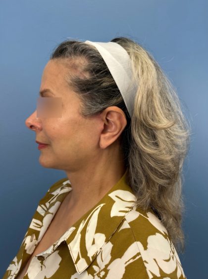 Facelift and Necklift Before & After Patient #16300