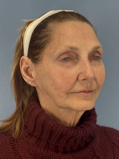 CO2 Laser Before & After Patient #16384