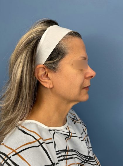 Facelift and Necklift Before & After Patient #16300