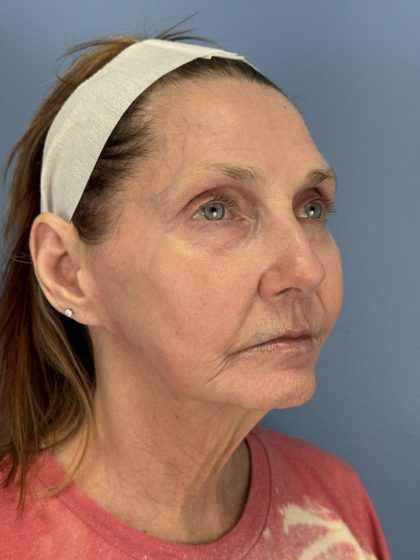 CO2 Laser Before & After Patient #16384