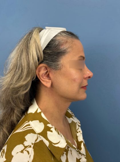 Facelift and Necklift Before & After Patient #16300