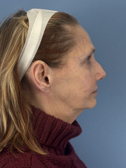 CO2 Laser Before & After Patient #16384