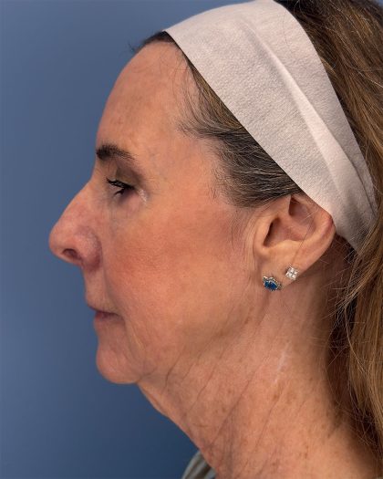 CO2 Laser Before & After Patient #16399