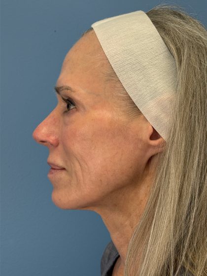 CO2 Laser Before & After Patient #16417