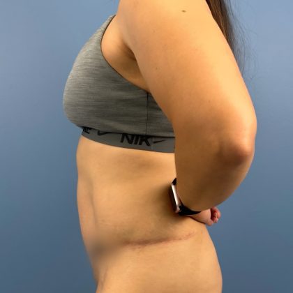 Tummy Tuck Before & After Patient #16339