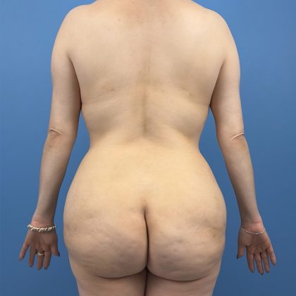Breast Augmentation Before & After Patient #16361