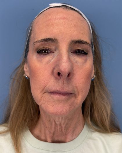 CO2 Laser Before & After Patient #16399