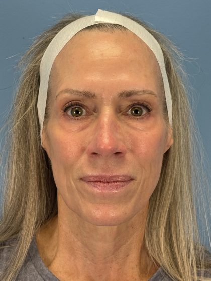 CO2 Laser Before & After Patient #16417