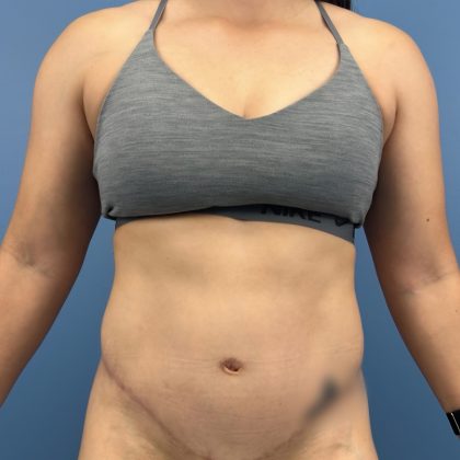 Tummy Tuck Before & After Patient #16339