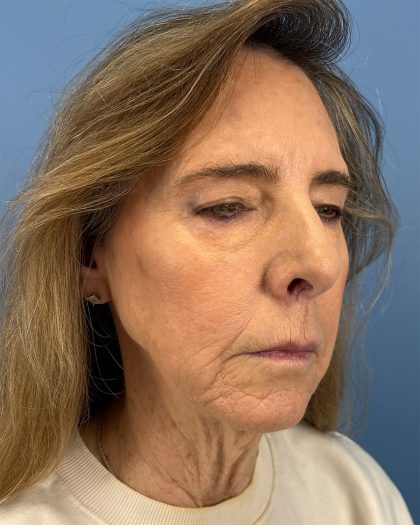 CO2 Laser Before & After Patient #16399