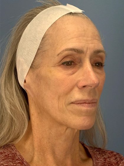 CO2 Laser Before & After Patient #16417