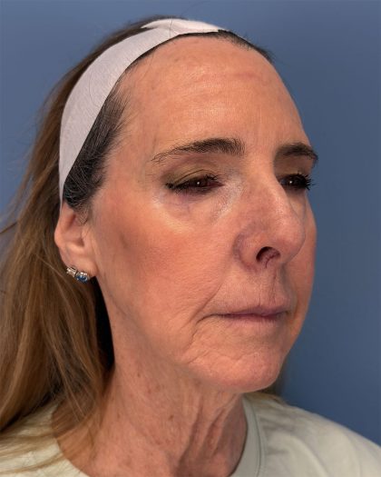 CO2 Laser Before & After Patient #16399