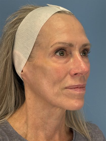 CO2 Laser Before & After Patient #16417