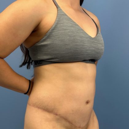 Tummy Tuck Before & After Patient #16339