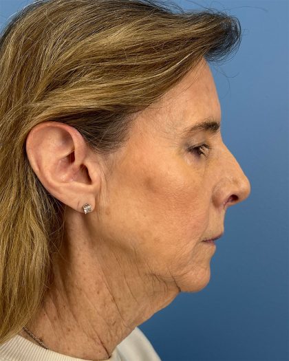 CO2 Laser Before & After Patient #16399