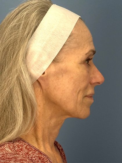 CO2 Laser Before & After Patient #16417