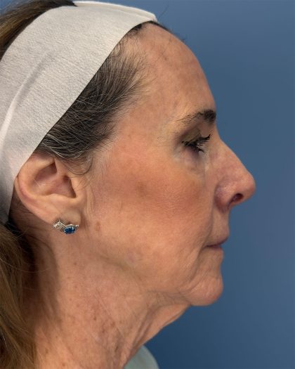 CO2 Laser Before & After Patient #16399
